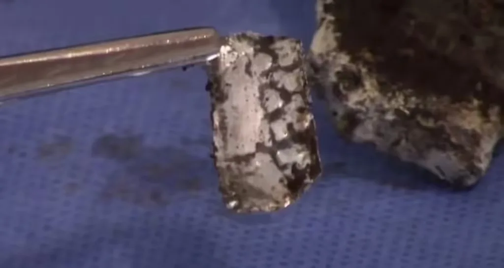 Metalni implantant
